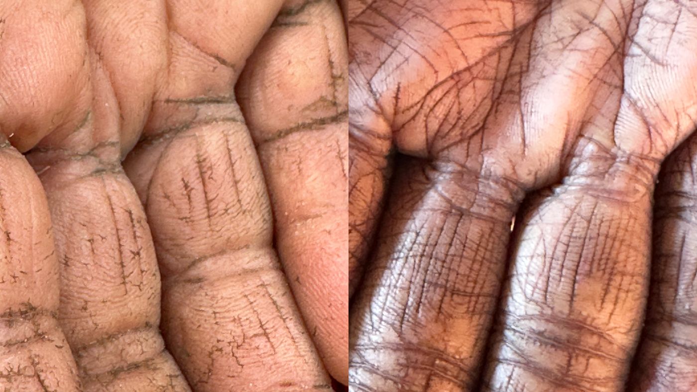 Field photos collected for the arsenicosis skin dataset